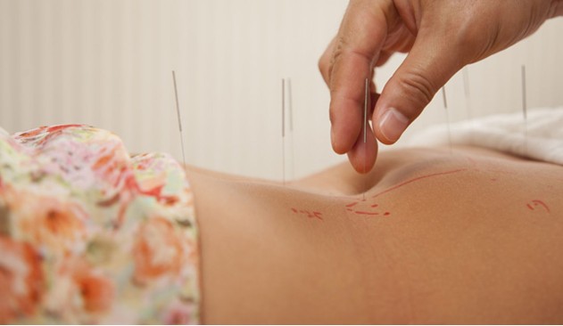 اثر طب سوزنی در درمان تنبلی تخمدان یا PCOS