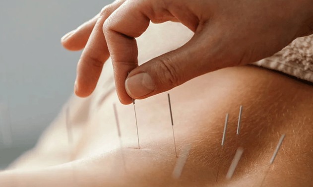 طب سوزنی در درمان تنبلی تخمدان چقدر طول می‌کشد؟